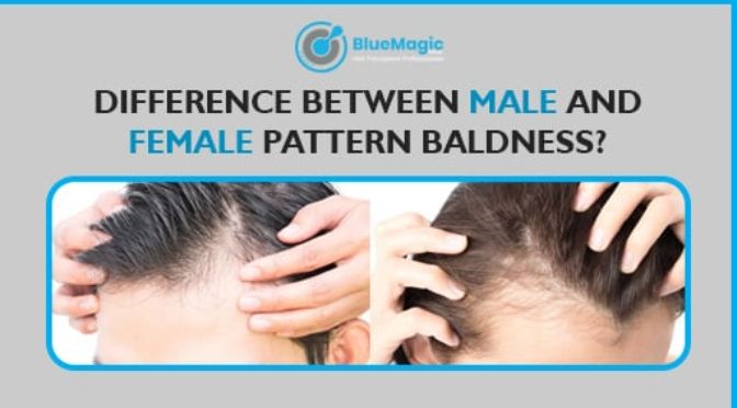 Difference between male and female pattern baldness | Blue Magic