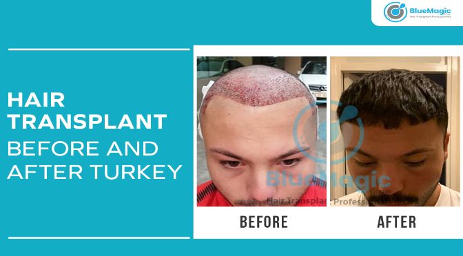 Hair Transplant Before And After Turkey - Hair Transplant Istanbul | Hair  Transplant Clinic Turkey | Professional Hair Transplant Treatment |  BlueMagic Group