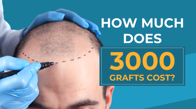 How much does 3000 grafts cost? | BlueMagic Clinic