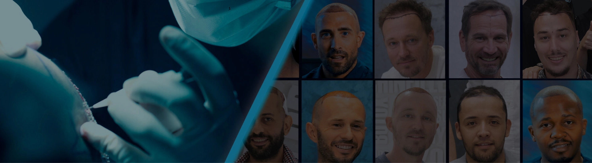 Hair Transplant Packages