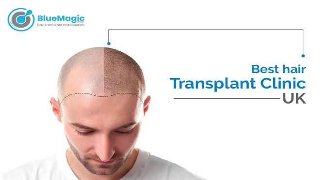 Hair Transplants UK - Hair Loss Solutions - Hair Transplant Clinics