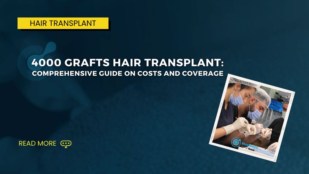 Understanding The 4000 Grafts Hair Transplant Bluemagic Group