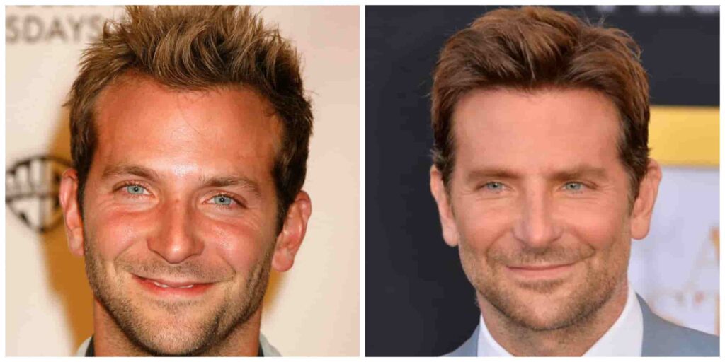 Bradley Cooper Hair Transplant Before and After Comparison