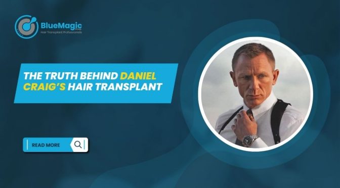 The Truth Behind Daniel Craig’s Hair Transplant