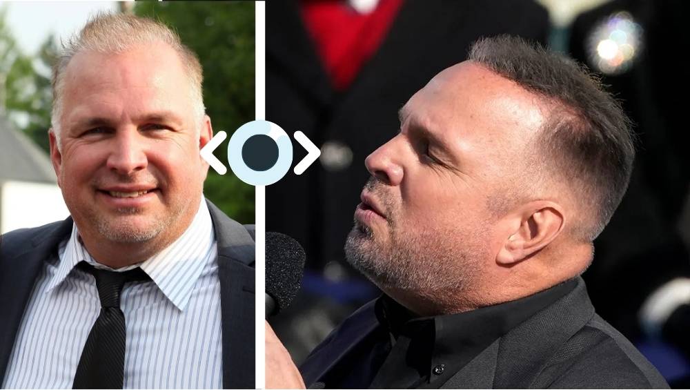 Garth Brooks Hair Transplant Before and After Images