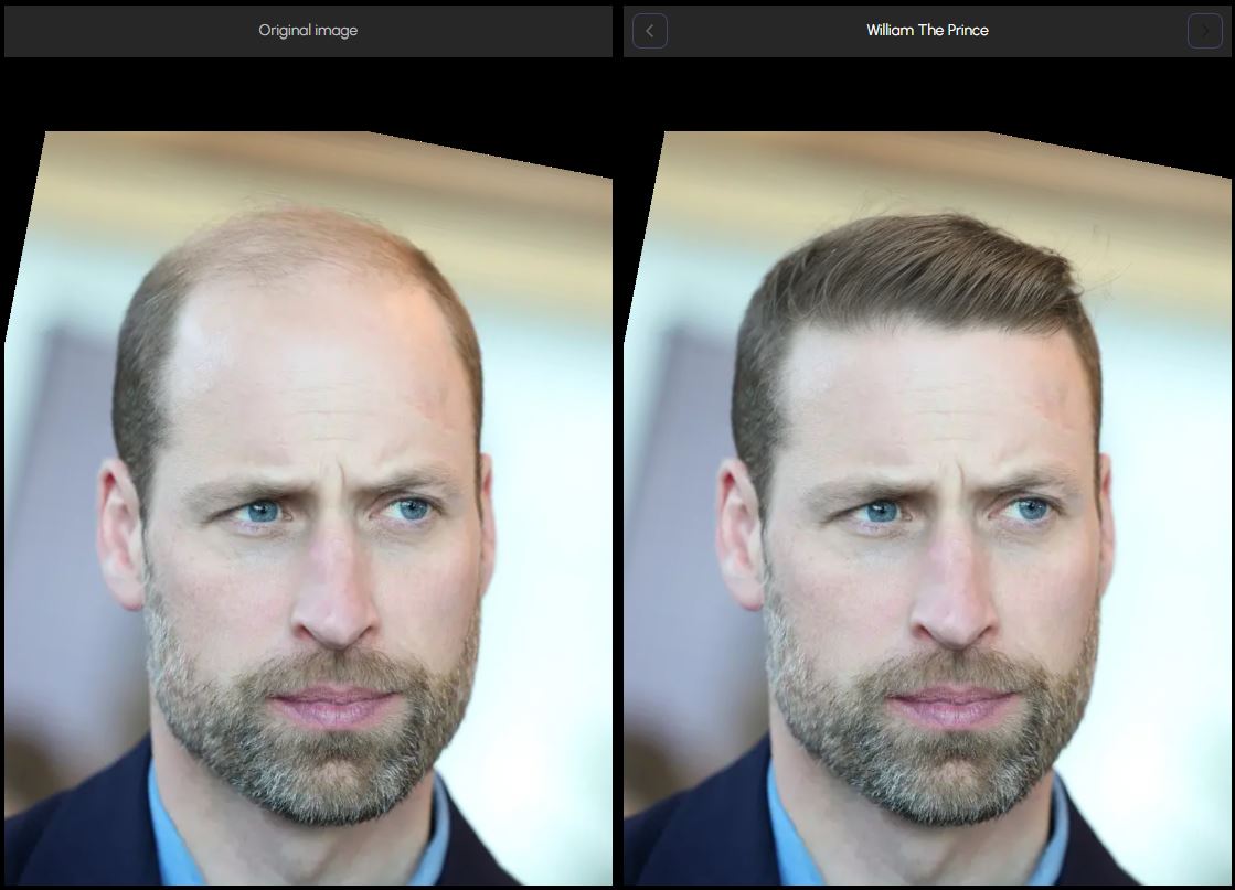 Prince William Hair Transplant Before and After Images